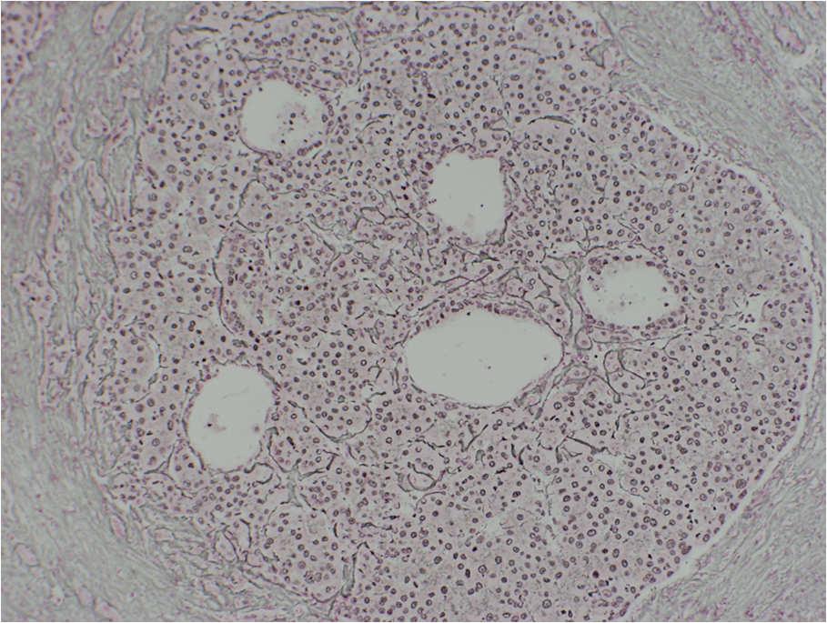 Reticulin Cirrhosis-like HCC (Variant HCC with Multifocality) Cirrhosis-like HCC (in cirrhosis) Diagnostic problem both clinically and microscopically May also have large dominant mass and smaller,