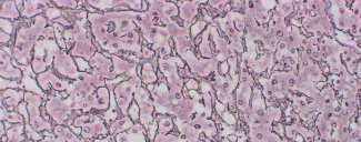 Adenoma (HCA): Historical Features Adenoma (HCA): Historical Histologic Features THE OLD