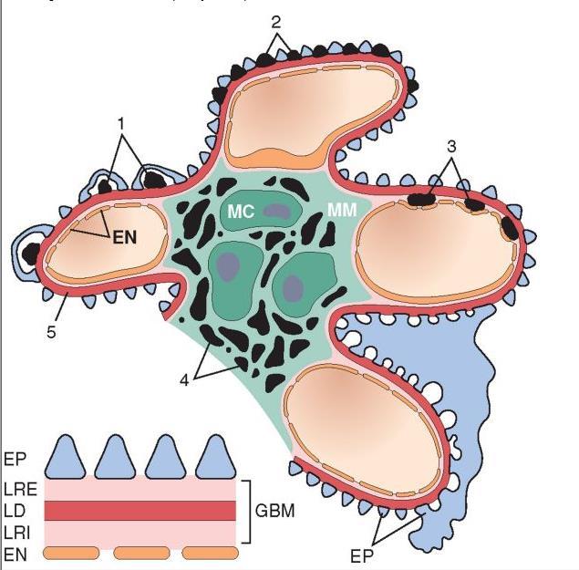 Localization of immune complexes in the Glomerulus 1. Subepithelial humps, 2. Epimembranous deposits, 3. Subendothelial deposits, 4. Mesangial deposits, 5.