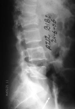 Out of 20 patients 8 were female (40%) and 12 were male (60%).All the patients had unstable burst fractures (100%).