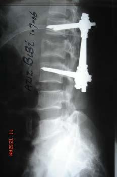 vertebral body fragments comprising thecal sac.