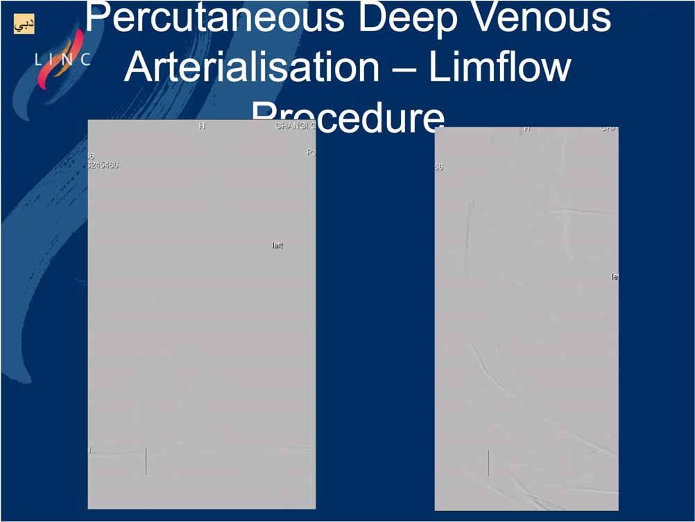 Percutaneous Deep Venous