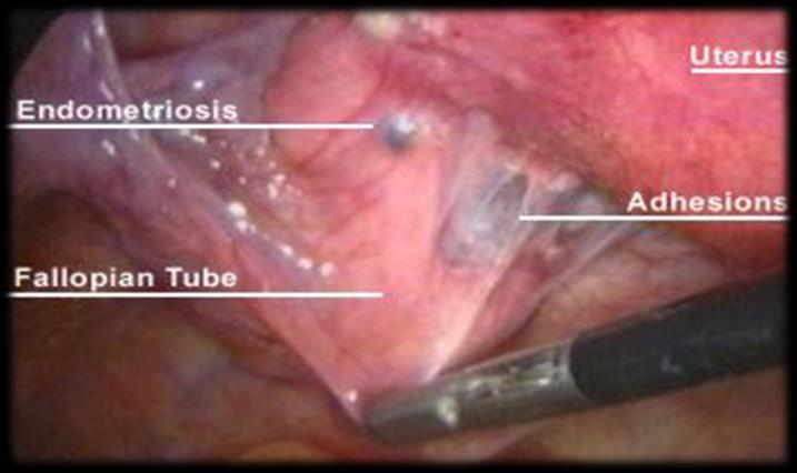 ablation either by electrocautery or laser improves