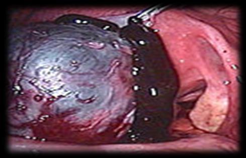 restoration of normal anatomy - Remove ovarian