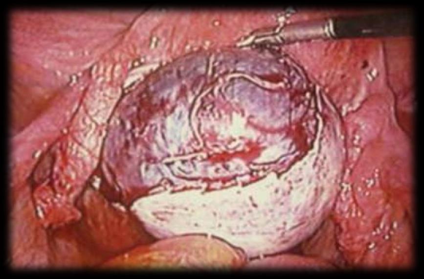 Endometrioma ( chocolate cyst ) The ESHRE 2014 Guideline, in infertile women ovarian endometrioma of > 3cm, laparoscopic ovarian cystectomy results in a better pregnancy rate than drainage alone.