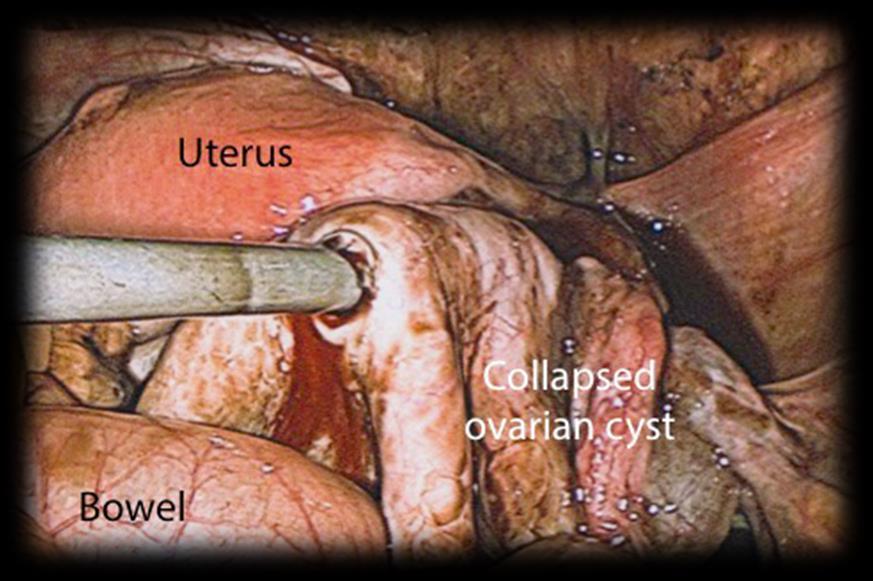 endometrioma are reported from 11 to 32% within 1-5 years after excision.