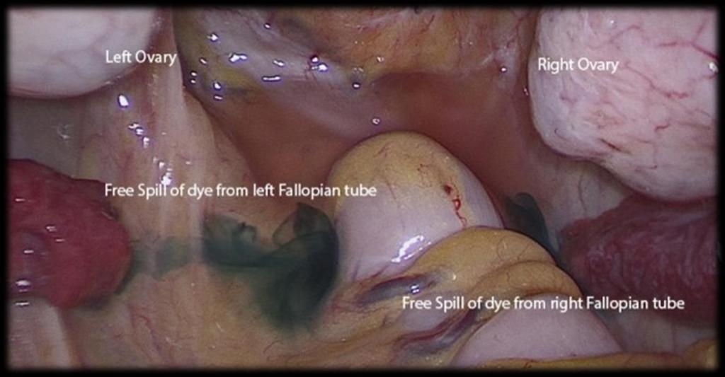 complete uterine septum Gold standard evaluation for tubal and