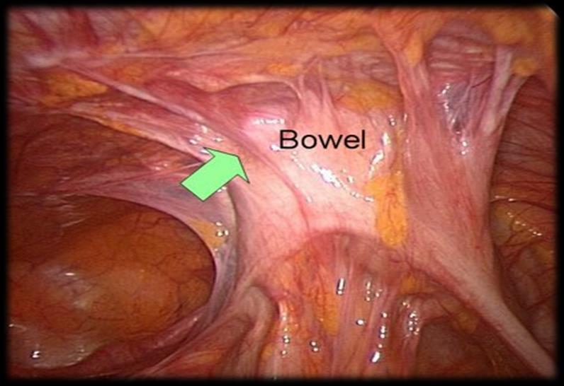 disease involving bowel, bladder