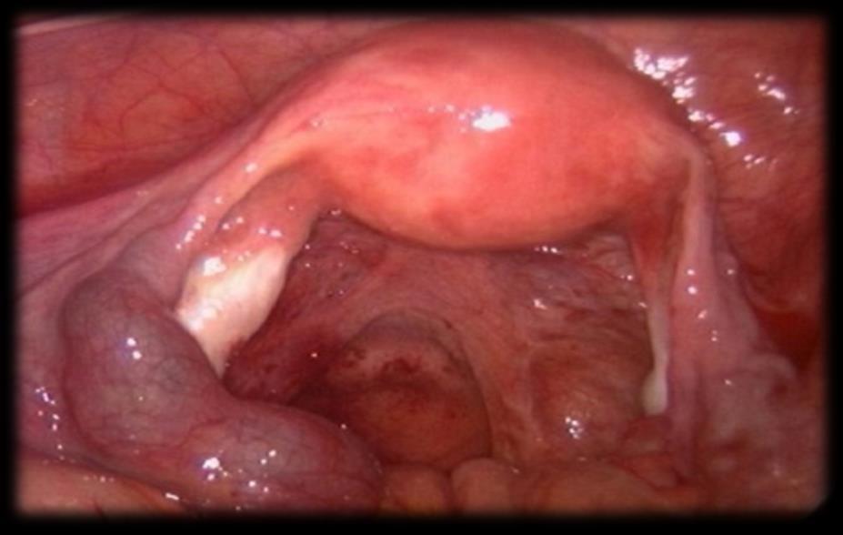 DISTAL tubal occlusion Hydro or Hematosalpinx dilated by fluid obstructed tube Unilateral hydrosalpinges excision with