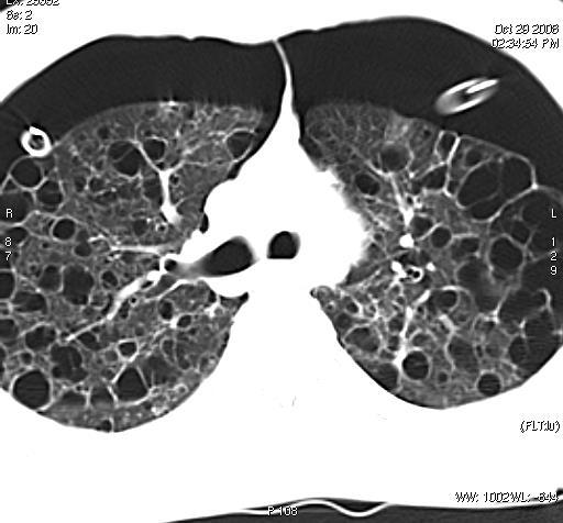 Pulmonary Langerhans Cell Histiocytosis X Pulmonary histiocytic sarcoma mimicking pulmonary Langerhans cell histiocytosis in a young adult presenting with spontaneous pneumothorax: a potential