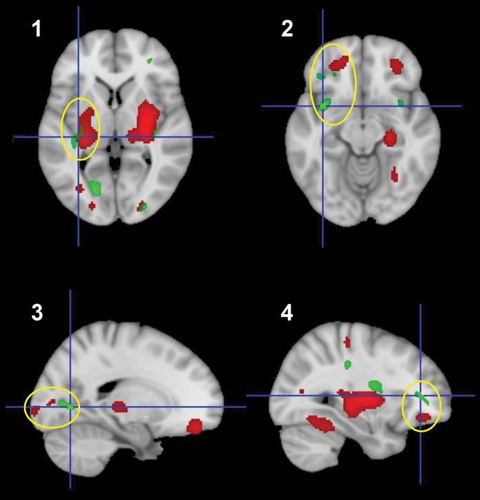 Figure 4. Spatial proximity of white matter regions with abnormal reductions in fractional anisotropy in SLE-2 patients and areas of increased metabolic activity in adjacent gray matter.
