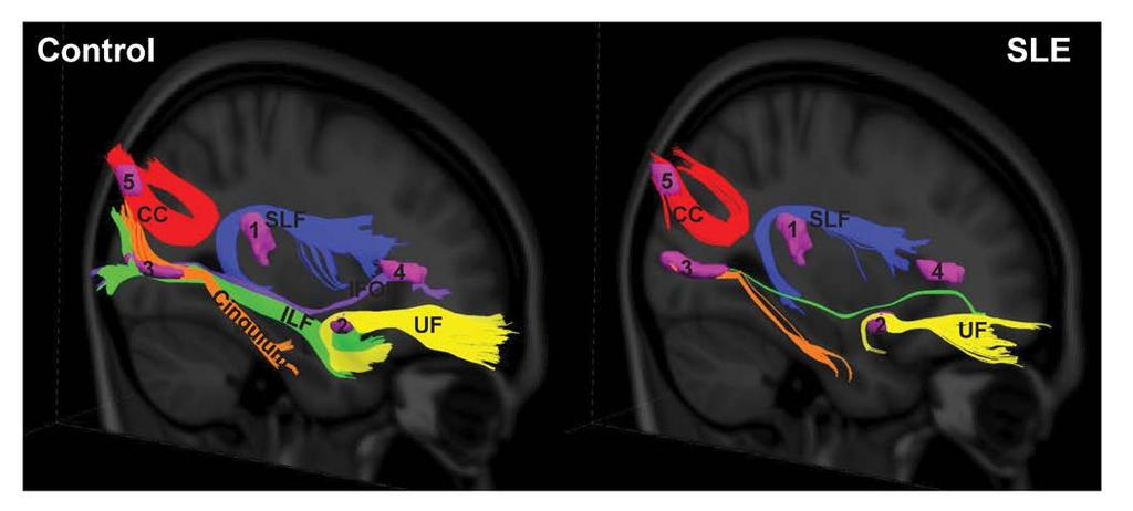 Figure 5. White matter pathways associated with the abnormal SLE-related regions visualized with group tractography.