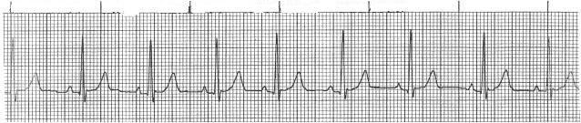 NSR is considered to be present if the heart rate is in the normal range, the P waves are normal on the ECG, and the rate does not vary significantly.