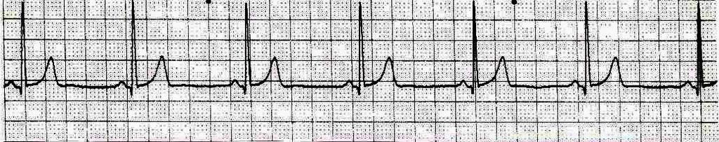 Sinus Bradycardia, may be caused by several factors such as increased vagal tone from vomiting, bearing down to have a bowel movement or from medications such as digitalis, calcium channel