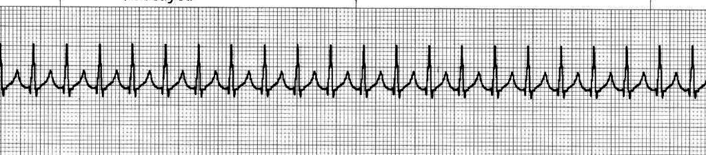Rate: > 150 BPM PRI: Usually <.12 sec QRS: Narrow, <.12 sec QT: <.40 sec Rhythm: Regular Source of pacer: Atrial re-entry current Characteristics: Tachycardias with a narrow QRS <.
