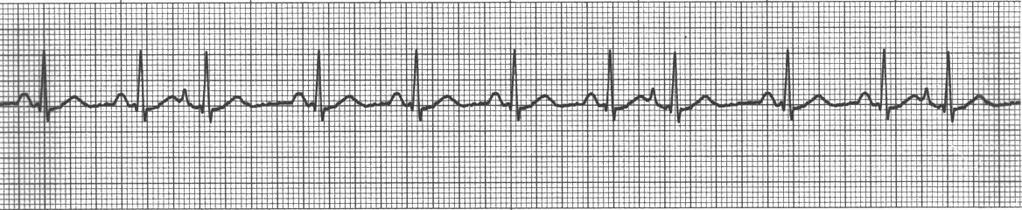 The rhythms can vary in name from Supraventricular Tachycardia (SVT), Atrial Tachycardia, or a rhythm that may speed up and slow down called Paroxysmal Atrial Tachycardia or Paroxysmal