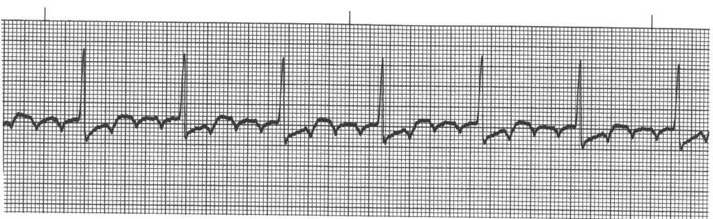 Junctional Rhythm Rate: 40-60 BPM PRI: Absent or variable QRS: Usually <.12 may be wider depending on pacer site. QT: <.