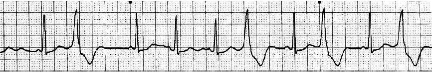 Premature Ventricular Contraction (PVCs) Rate: Depends on the underlying rhythm Rhythm: Depends on the underlying rhythm.