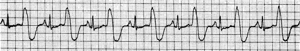 PVCs may also occur in succession. When this happens, the PVCs are called a Couplet. (The strip above also shows a couplet.