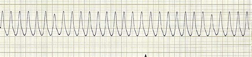 Rate: 100 250 BPM PRI: P waves may be present if SA node is functional, however there is no relation to the QRS.
