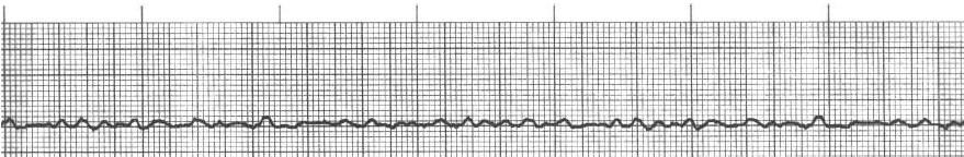 rapid electrical stimuli. The stimuli are chaotic resulting in no organized ventricular depolarization. The ventricles do not contract because they never depolarize. For you visual learners.