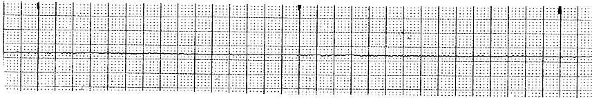 Asystole Rate: None P waves: None PRI: None QRS: None QT: None Rhythm: None Source of pacer: None Nursing Tip: Assess your patient! Treat the patient and not the monitor!