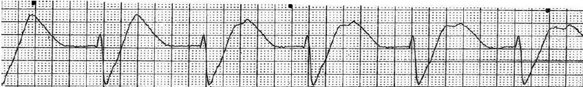 If the rate is >40 bpm, it is called accelerated idioventricular rhythm. The rate of 20-40 is the "intrinsic automaticity" of the ventricular myocardium.