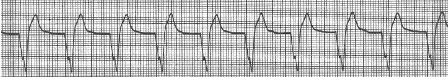 Rate: 40-100 bpm Rhythm: Irregular QRS: Wide - If the QRS is wider than 0.