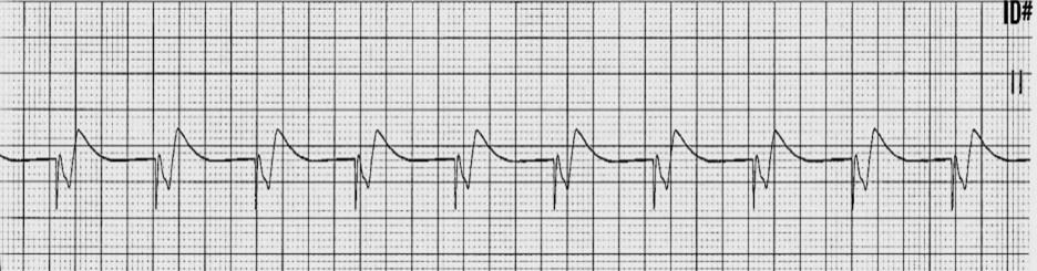 Types: Temporary: used to sustain HR in an emergency situation: Transcutaneous (TCP)-external cardiac pacing, Transvenous-lead wire threaded through the skin into a large vein Indications: