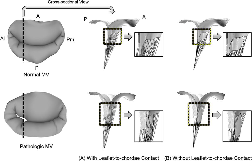 Rim et al. BioMedical Engineering OnLine 2014, 13:31 Page 6 of 11 Figure 3 Leaflet deformation at peak systole with and without incorporation of leaflet-to-chordae contact interaction.