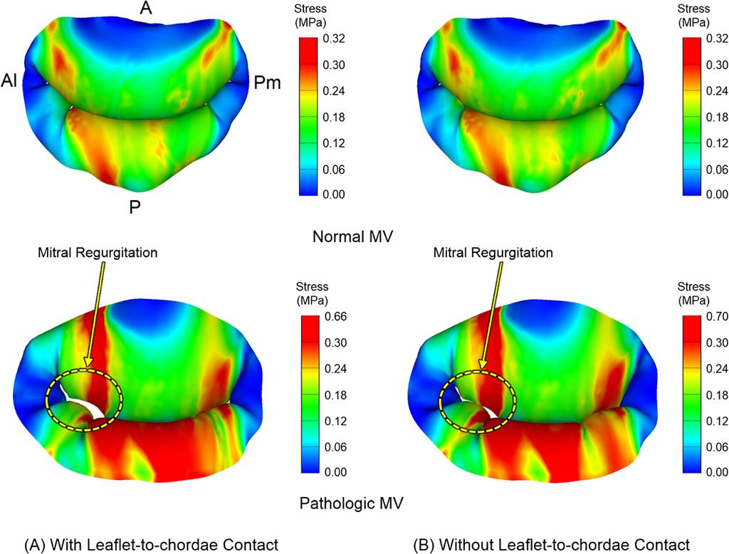 Rim et al. BioMedical Engineering OnLine 2014, 13:31 Page 8 of 11 interaction (6.9 mm) than for the simulation with leaflet-to-leaflet contact alone (2.6 mm).