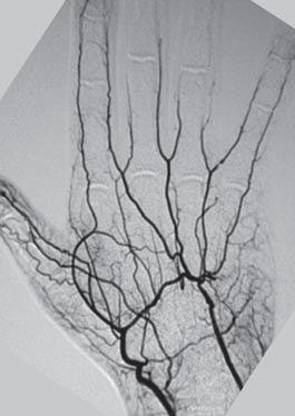 hypothenar mass. There may be increased capillary refill time, along with a positive Allen test. Differential diagnoses 1. Primary Raynaud s disease 2.