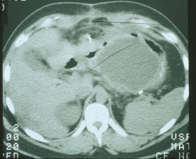 incomplete exam due to overlying bowel gas) Abdominal CT