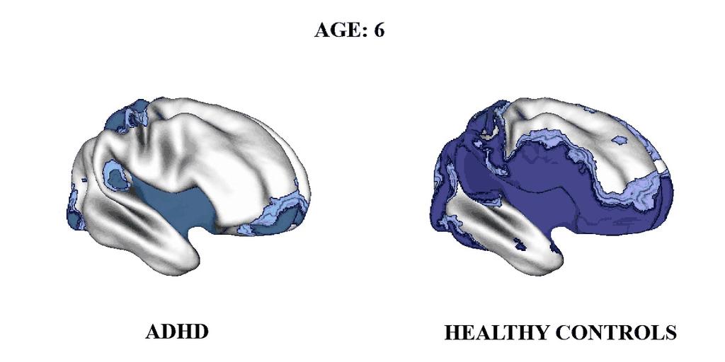 Age of attaining peak cortical thickness for the ADHD and healthy control groups: ADHD has shift to the right The darker colors indicate regions where a quadratic model was not appropriate and thus a