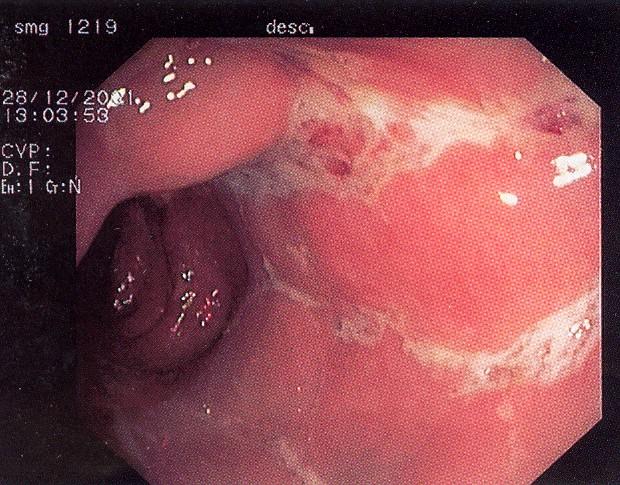 lesions > endoscopic samples