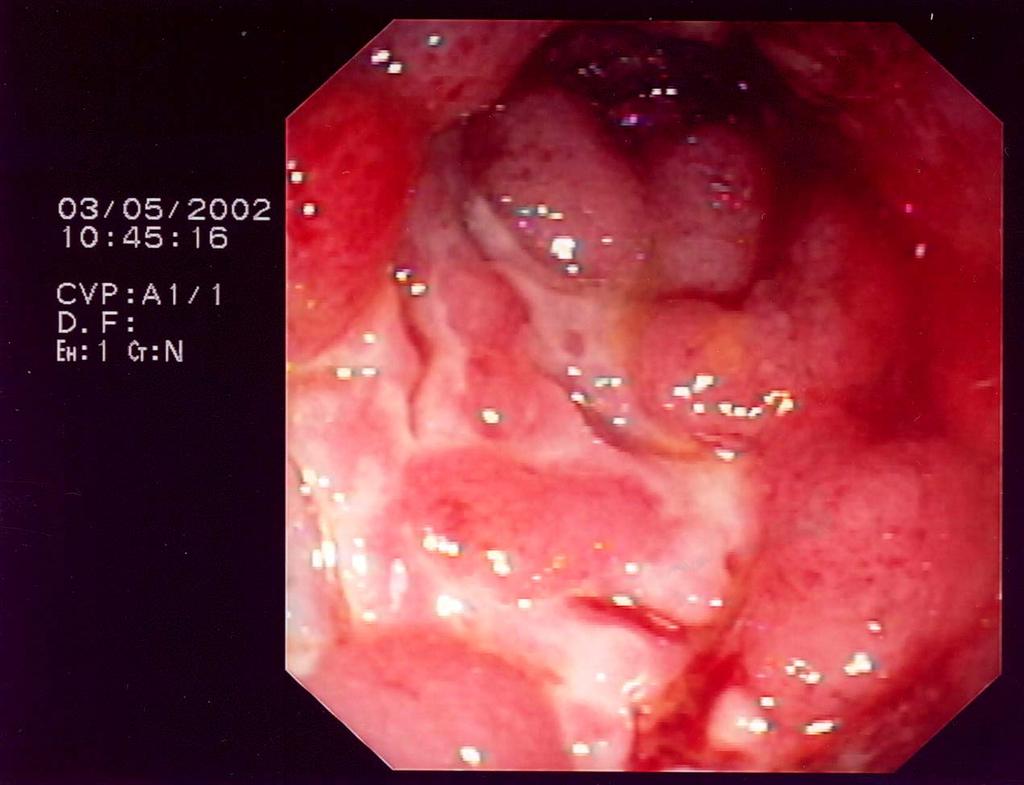 Recurrence of ulcers in the same