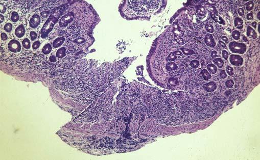 and loss of epithelial cells Epithelial patchy necrosis Mucosal microulcerations