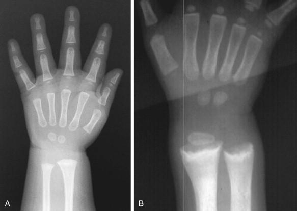 Wrist x-rays in a normal child (A) and a child with rickets (B).