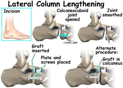 After several months, the brace is replaced with a foot orthotic. Lateral column lengthening involves the use of a bone graft at the calcaneocuboid joint.