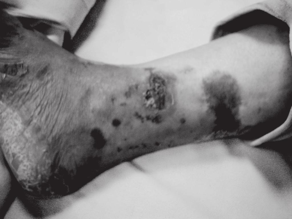 lesions of hands, severe onychoschizia.
