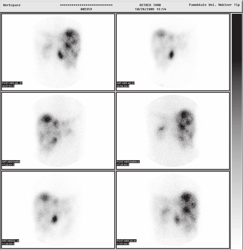 Figure 3 Scintigraphy with 111 indium-labeled octreotide, multiple cystic lesions in the liver and additional lesions in the ileocecal region (Left panel: anterior, Right panel: posterior abdominal