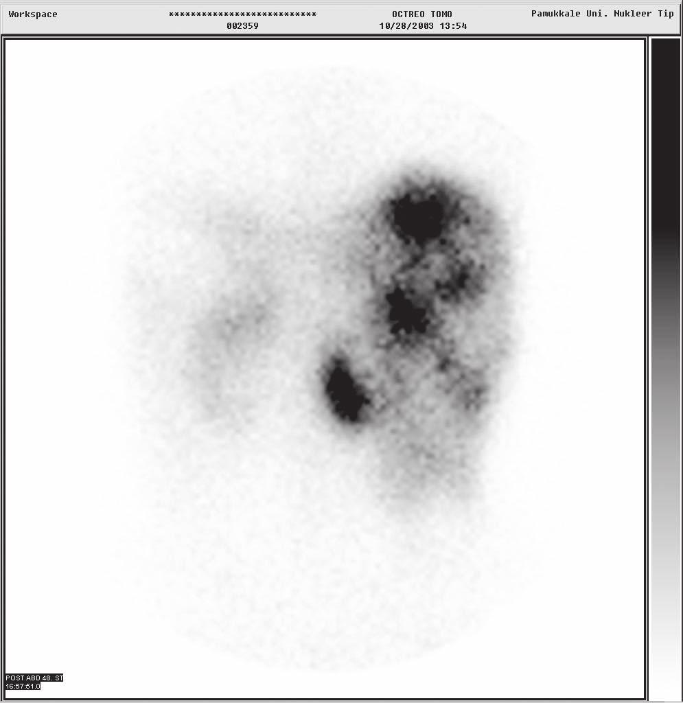 Fenkci et al.: Malign cystic glucagonoma Figure 4 Scintigraphy with 111 indium-labeled octreotide (posterior abdominal view). hepatic metastases (Fig. 5).