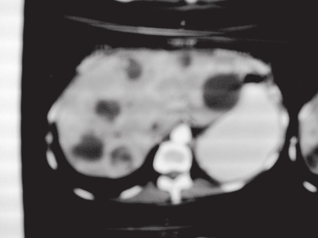 Figure 5 CT of the abdomen, extensive liver metasteses in the liver, up to 7 cm in diameter. hepatic metastases but additional iliocecal lesions were shown by somatostatin-receptor scintigraphy.