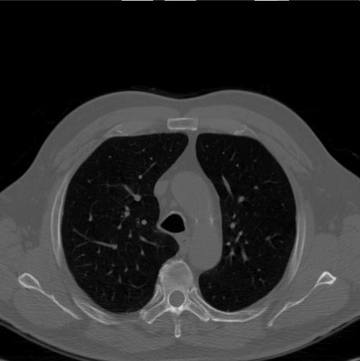 DATA This study included 24 low-dose chest CT scans, randomly chosen from a set of baseline scans acquired in the National Lung Screening Trial (NLST)6.