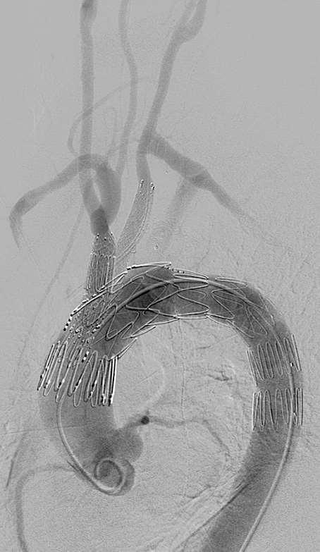 Cook Branched Arch Endograft Hamburg Experience 2012-2017: Cases: 54 Aneurysm/PAU: 28 Residual dissection: