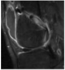 (Nin et al, Arthroscopy 2009) Prospective, randomized, double-blind study, level of evidence 1 ACL reconstruction using bone-patellar tendon-bone allograft (100 patients) Platelet-enriched gel vs no