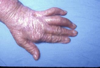 hand. Treated with cobalt