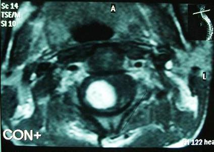 After about 1 year the patient presented with Figure 6: MRI Cervico