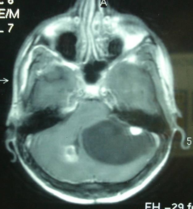 Amir Aziz, et al Figure 8: Pre-operative MRI Brain. Figure 9: Tumor excised. headache, vomiting and lower limb weakness.