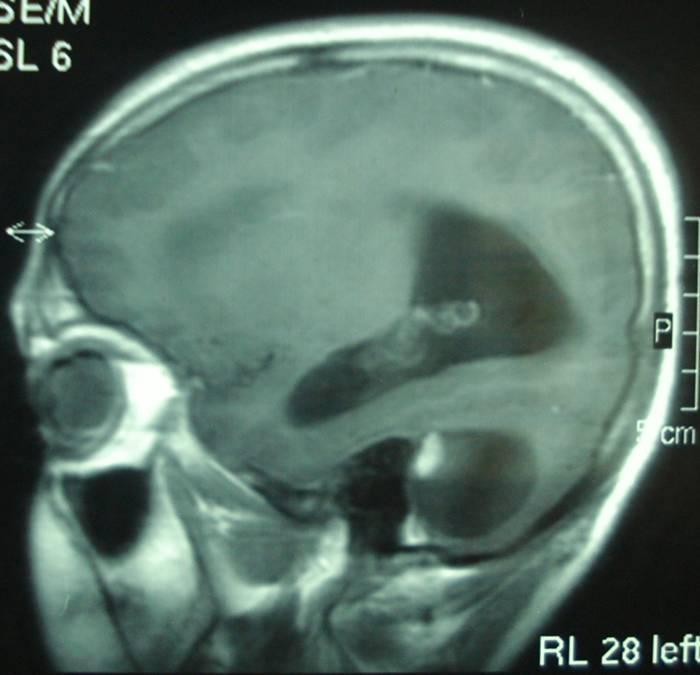 Retromastroid Sub-occipital craniectomy was performed and a large cystic cerebellar lesion with dark reddish colored nodule